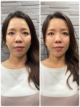 長寿鍼灸院 長寿整骨院/美容鍼50本の効果★小顔効果