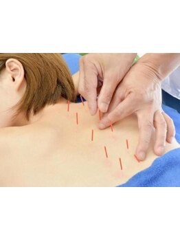 鍼灸施術を受けたい