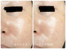 エミー(emy)/江坂/毛穴/ハーブピーリング