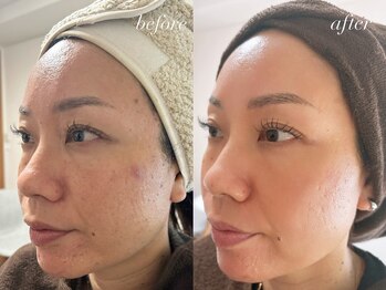 サロン ベレ プー(Salon Belle Peau)/before/after