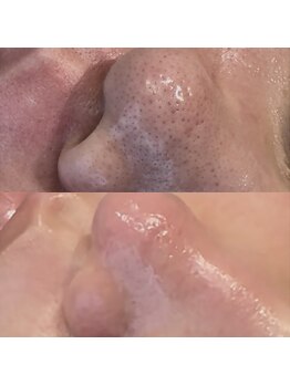 アマト 心斎橋店(Amato)/心斎橋/毛穴洗浄/ワックス脱毛