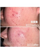 ミニョン(mignon)/市販のクレンジングの怖さ、、、