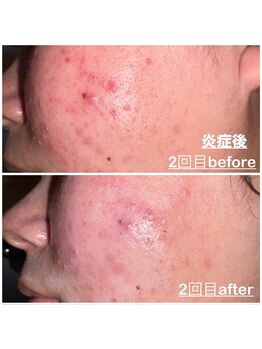 ミニョン(mignon)/市販のクレンジングの怖さ、、、