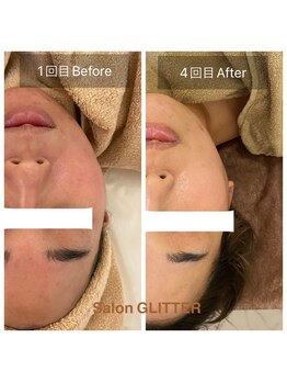サロン グリッター 新宿(Salon GLITTER)/【肌質改善】ビフォーアフター