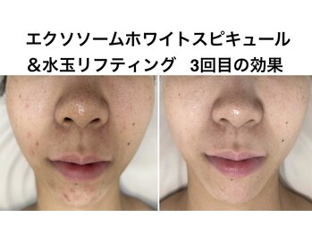 ハナ トータル ケア(Hana Total Care)/エクソソームホワイトスピキュー