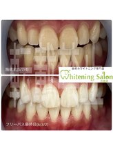 ホワイトニングサロン 広島店/【ホワイトニング施術例】