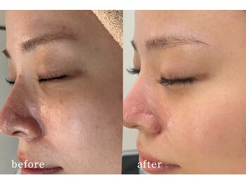 サロンムーン 赤坂(salon moon)/跡のケアで-10歳の印象肌