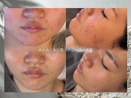 キュレイテッドスキン(CURATED SKIN)の写真