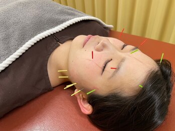 けん鍼きゅう整骨院の写真/《女性限定★美容鍼で気になるシワやほうれい線を改善◎》首肩こりも施術してお疲れ顔がスッキリ!