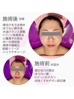 ライゼ(REISE)/ビフォーアフターご紹介【毛穴】