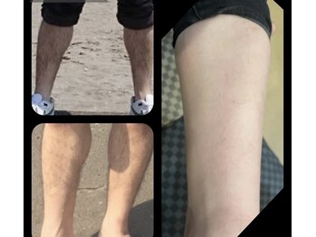 ミミー ヒロサキ(MiMiy HIROSAKI)/男性脚脱毛Before After