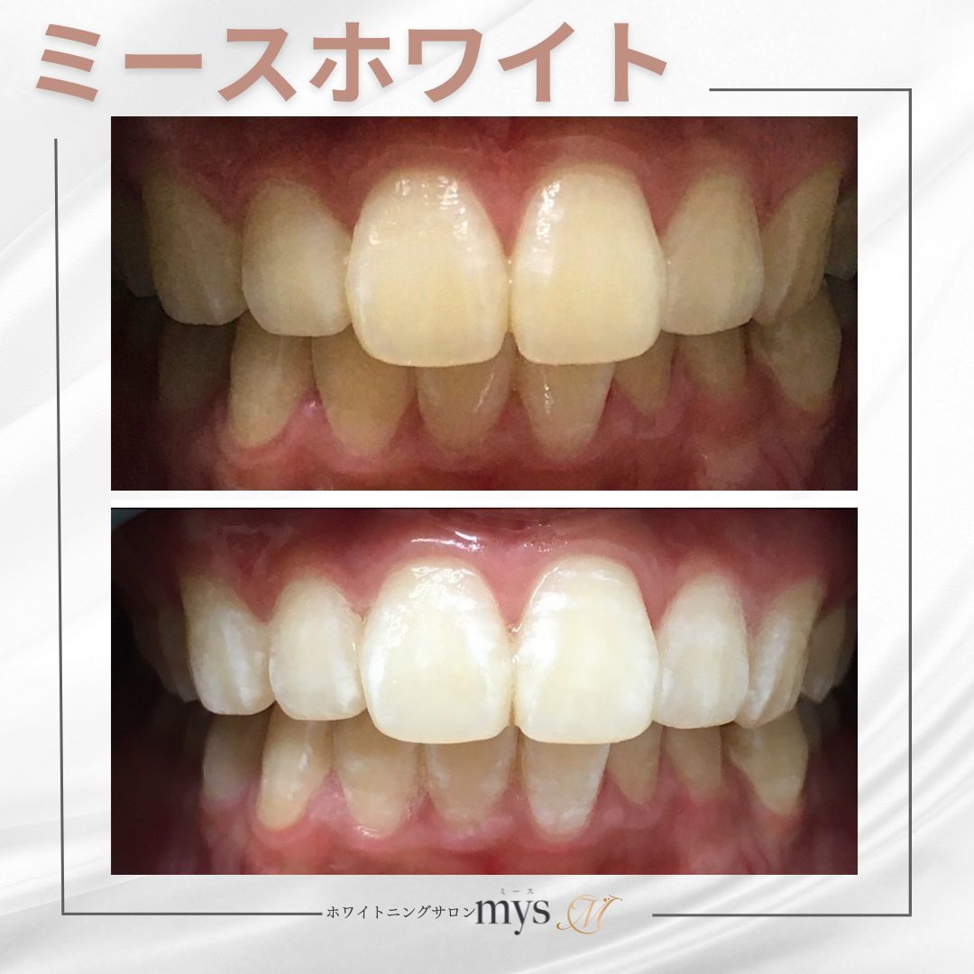【メンズ限定】セルフホワイトニング　初回\2,200
