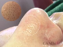 キャンディ 難波心斎橋店(CANDi)/ハイドラピーリング/黒ずみ毛穴