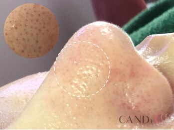 キャンディ 難波心斎橋店(CANDi)/ハイドラピーリング/黒ずみ毛穴