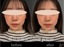 チョコバリ 新宿店(chocobari)/小顔×リフトアップ(美容鍼)20代