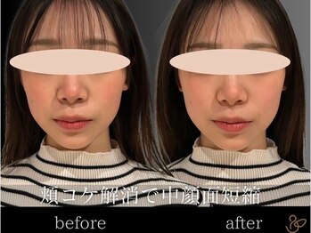 チョコバリ 新宿店(chocobari)/小顔×リフトアップ(美容鍼)20代