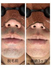 アカラ 読谷店(AKALA)/ヒゲ脱毛３か月経過