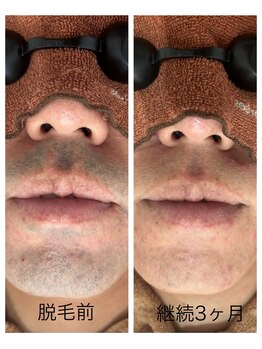 アカラ 読谷店(AKALA)/ヒゲ脱毛3か月経過
