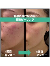 グリーンルーム(green room)/敏感、赤み、ニキビケア5回