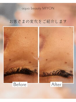 アクアビューティ ミヨン(Aqua beauty MIYON)/before &nbsp;after