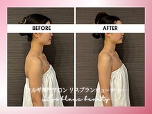 リスブランビューティー(Lys Blanc Beauty)/９０分コルギBefore×After