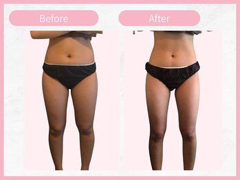 RHB東戸塚/痩身エステはRHB東戸塚