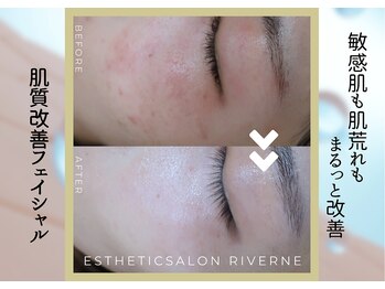 リヴェーヌ 富山店の写真/《毛穴が目立つ乾燥肌を潤い美肌へ》あなたに合う施術を豊富な知識＆メニューからご提供★