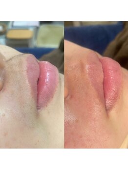 ナチュウル(Natulu)/シルク糸脱毛