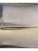 ルアナアイナ(Luana Aina)/二の腕ケア/ハーブピーリング