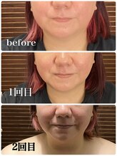 愛 まぁる/40代 2週間間隔２回各2cc 