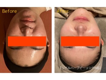 ロイヤリティ(ROYALTY)/ニキビ/お肌の凹凸/肌のごわつき