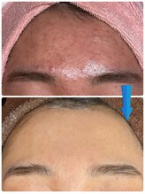 ジョンミー(JONMEE)/毛穴ニキビにハーブピーリング