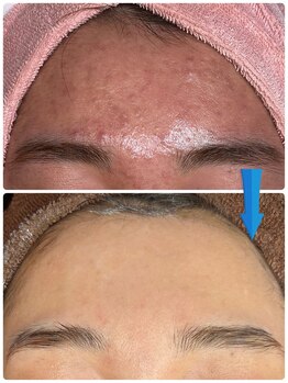 ジョンミー(JONMEE)/毛穴ニキビにハーブピーリング