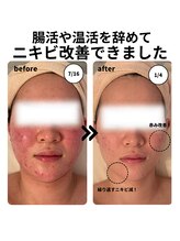 マヴィ(Ma vie)/ニキビ改善