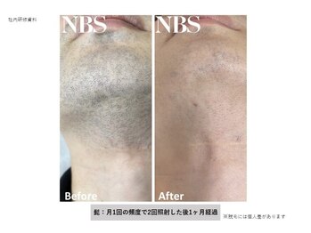 ビュール(VIERU)/メンズ部分脱毛【首・髭】