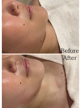 グランディール(GRANDIR)/肌質改善・小顔コース