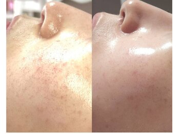 シューン(schon)/グリーンピール　５Days