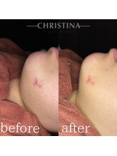 イデアル(Ideal)/【肌質改善】乳酸菌ピーリング