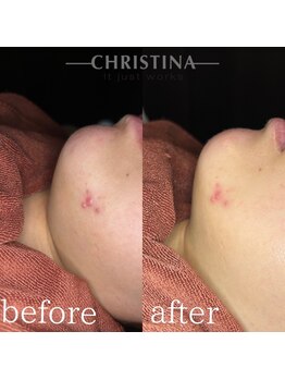 イデアル(Ideal)/【肌質改善】乳酸菌ピーリング