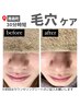 【毛穴が気になる】毛穴詰まり・開き/いちご鼻に◎毛穴ごっそり洗浄