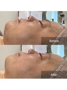 アイ(I)/キュッと引き締まりたるみ改善