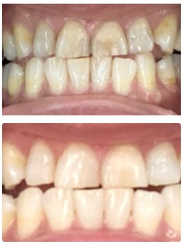 コントレール 歯ぁと(CONTRAIL)/加齢によるくすみが明るく！