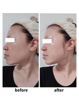 ファウンデーション(FOUNDATION)/ハーブピーリング