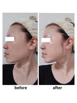 ファウンデーション(FOUNDATION)/ハーブピーリング