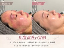 アンヘル(Angel)の雰囲気（リアボーテを中心に、お肌の状態に合わせたケアを継続）