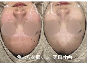 アルフォービューティー 難波店(ALU for beauty)/シミ・美白症例