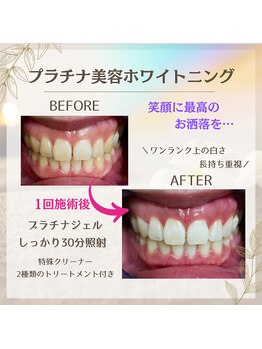 ホワイトニングプラス(Whitening+)/プラチナ美容ホワイトニング
