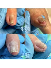 巻き爪補正店 川崎駅前店/手の巻き爪ケア