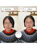 【3回クーポン】美容鍼＋小顔矯正《1回￥11000→3回￥26400》