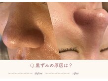 オートクチュール エステティックサロン シーズ/Q.黒ずみの原因は？